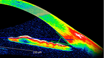 1st 수직형 난시교정ICL 개발